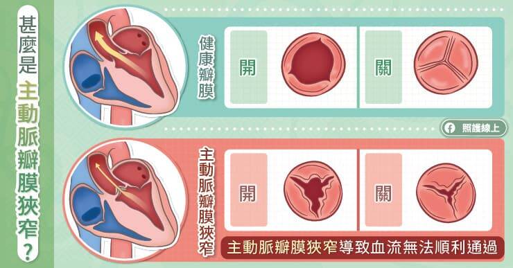 照護線上》老翁感冒喘不停「以為得肺炎」真兇竟是主動脈瓣膜狹窄