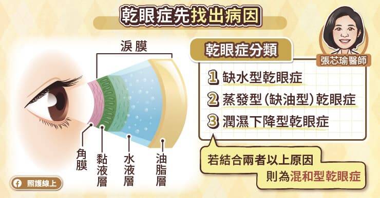 照護線上》眼睛乾澀、容易疲勞，先確定乾眼症分類，才能選擇正確治療，眼科醫師圖文解說