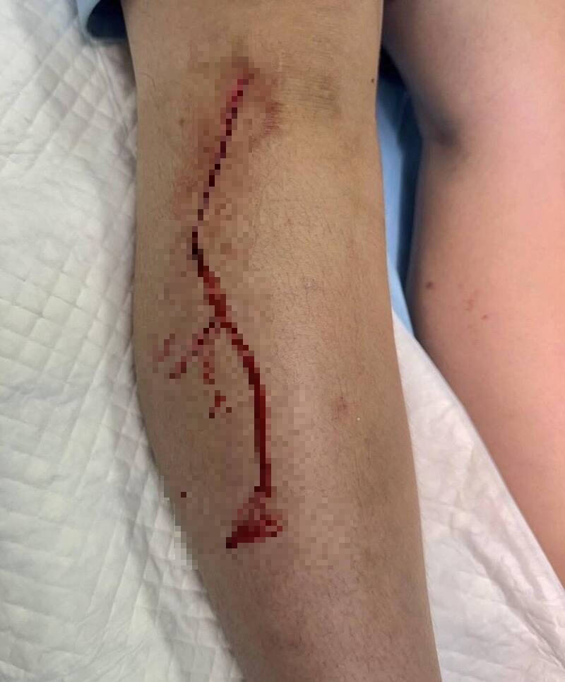 屏縣某國中校園，9月初傳出國中生被同學持美工刀劃傷，縫了十多針。（家屬提供）