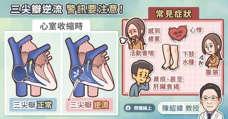三尖瓣逆流常見症狀包括心悸、疲累、下肢水腫、腹脹、黃疸、肝臟衰竭等。（取自貼文）