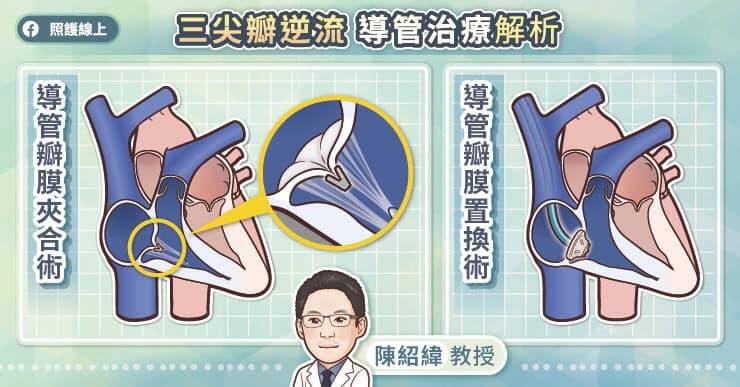 林口長庚醫院心臟血管外科主任陳紹緯說明，導管瓣膜夾合術是利用導管進入右心室，在超音波影像的輔助下，利用夾子夾住三尖瓣，改善逆流狀況。（取自貼文）