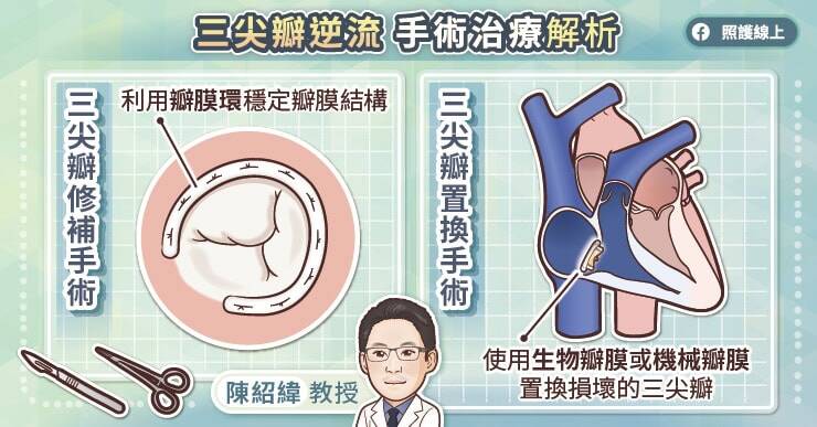 林口長庚醫院心臟血管外科主任陳紹緯指出，三尖瓣修補手術的手術時間較短、風險較低。（取自貼文）