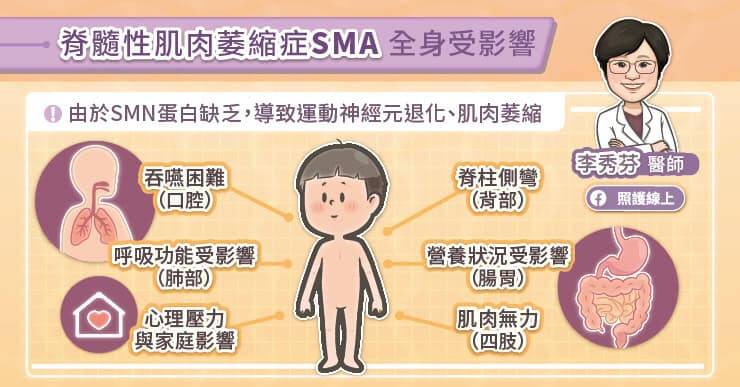 罹患脊髓性肌肉萎縮症會出現肌肉無力、萎縮、吞嚥困難與呼吸功能受損等情形。（取自貼文）