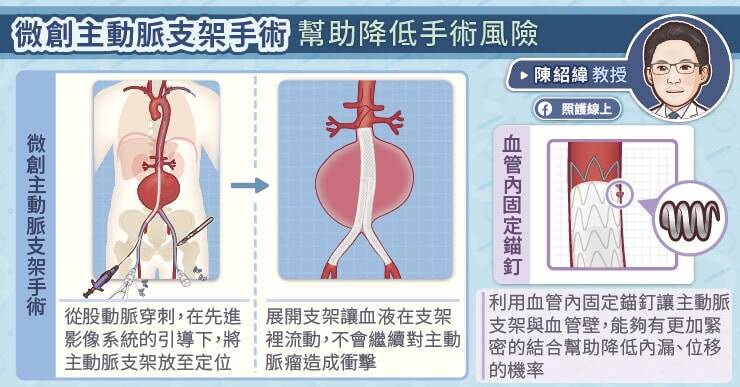 接受微創主動脈支架手術後，一定要持續回診追蹤。林口長庚醫院心臟血管外科主任陳紹緯教授說，有10％到20％的病人，在長期追蹤中會發現主動脈支架移位、主動脈支架滲漏的問題，可能需要二次手術再次治療。（取自貼文）