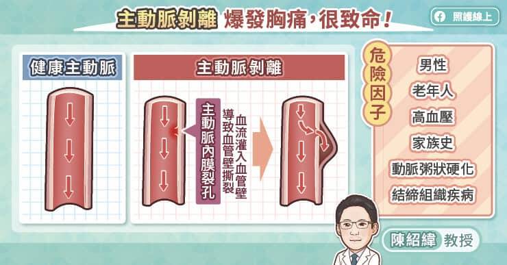 主動脈剝離較常出現在男性，危險因子包括高血壓、老年人、動脈粥狀硬化、結締組織疾病、家族病史等。（取自貼文）