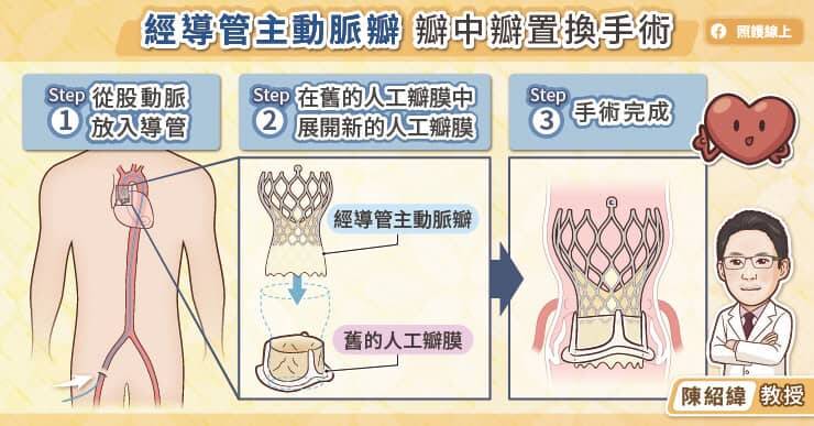 經導管主動脈瓣瓣中瓣置換手術是由鼠蹊部股動脈置入導管，在先進影像系統的導引下延伸至主動脈瓣的位置，然後展開新的經導管主動脈瓣。（取自貼文）