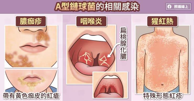 與A型鏈球菌相關的感染包括了膿痂疹，咽喉炎，與猩紅熱。（取自貼文）