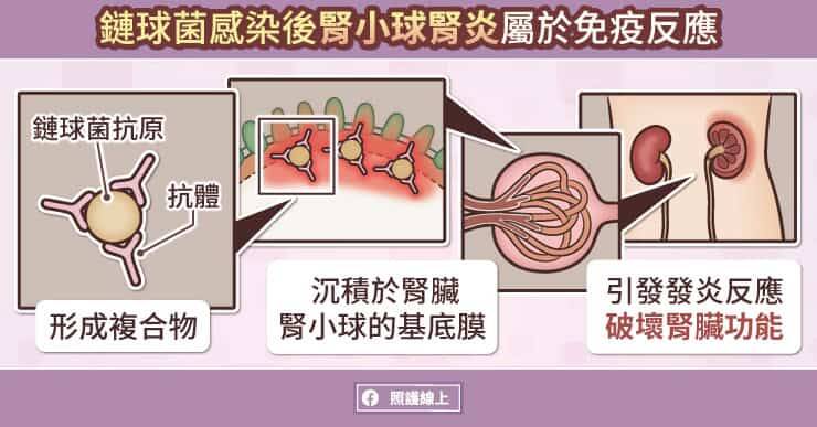 鏈球菌感染後腎小球腎炎屬於免疫反應，並不會傳染。（取自貼文）